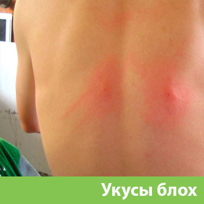 Укусы блох в Владивостоке