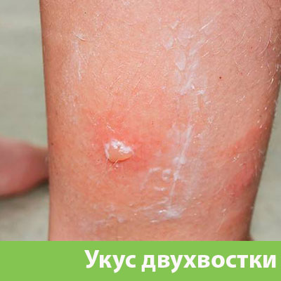 Укус двухвостки в Владивостоке