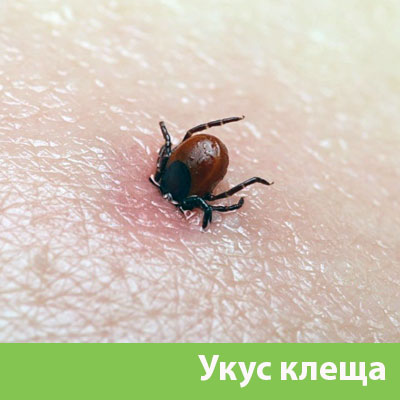 Укус клеща в Владивостоке