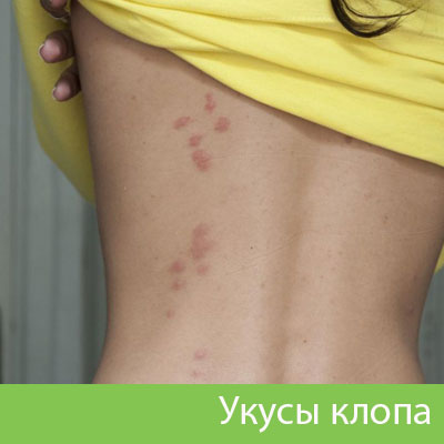 Профессиональное уничтожение клопов в Владивостоке